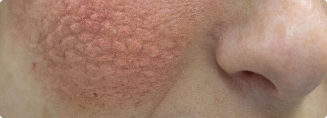 A cheek rash is common symptom of lupus