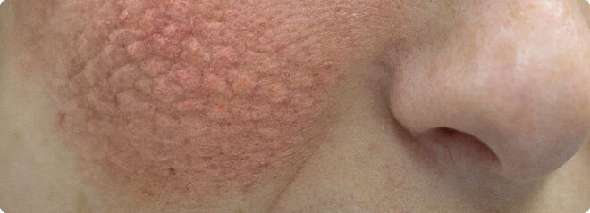 Facial rash is a common symptom of lupus