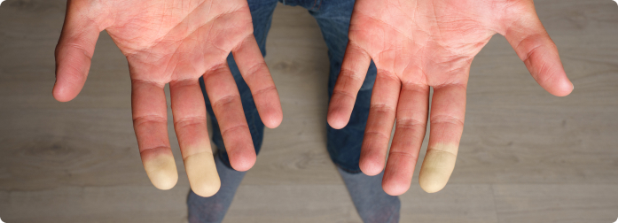 A patient's hands palm-up displaying some color change on the finger tips