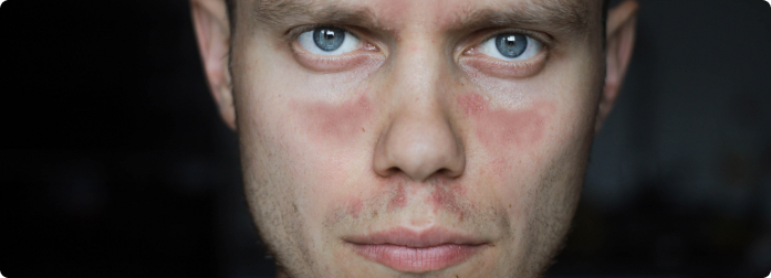 Headshot of a lupus patient with facial rash looking straight at the camera